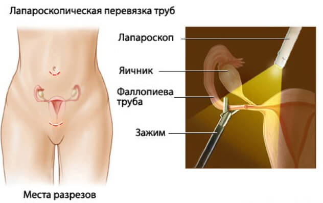 Перевязка маточных труб в Южная Корея